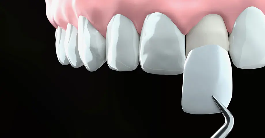 ラミネートベニア