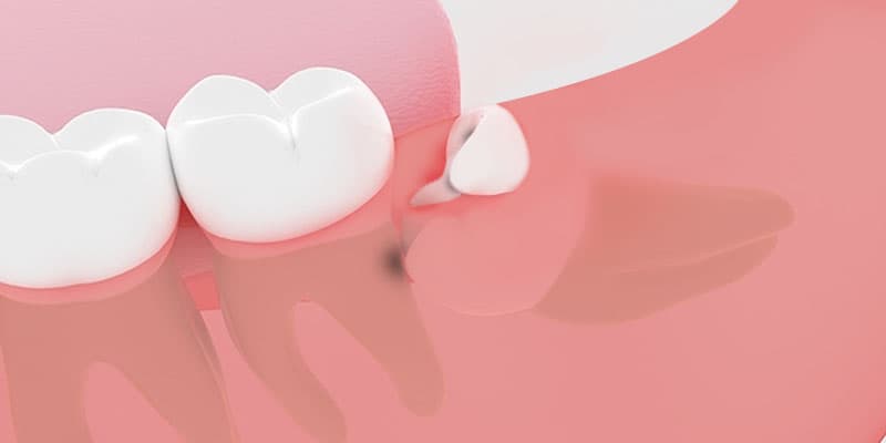 虫歯を引き起こしやすなる