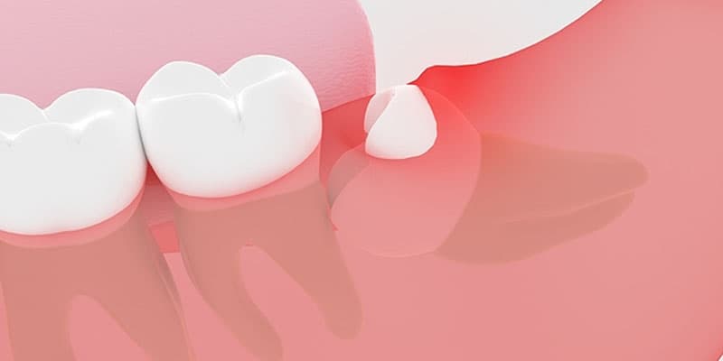 歯周炎を引き起こしやすなる