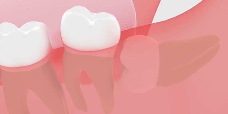 歯並び悪化の可能性がある