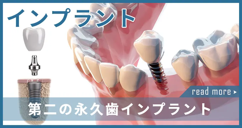 インプラント