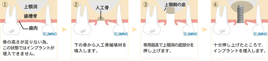 サイナスリフト法