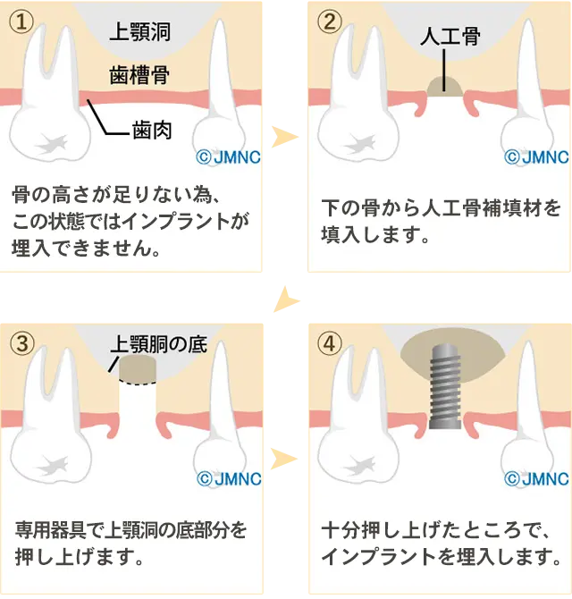 サイナスリフト法