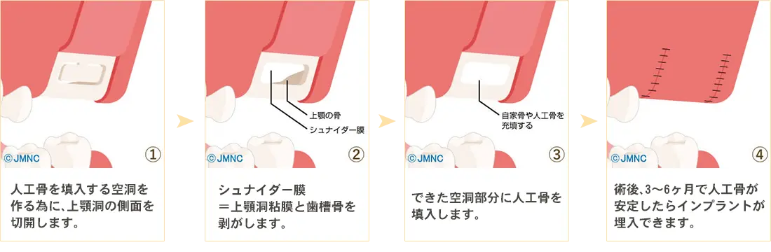 サイナスリフト法